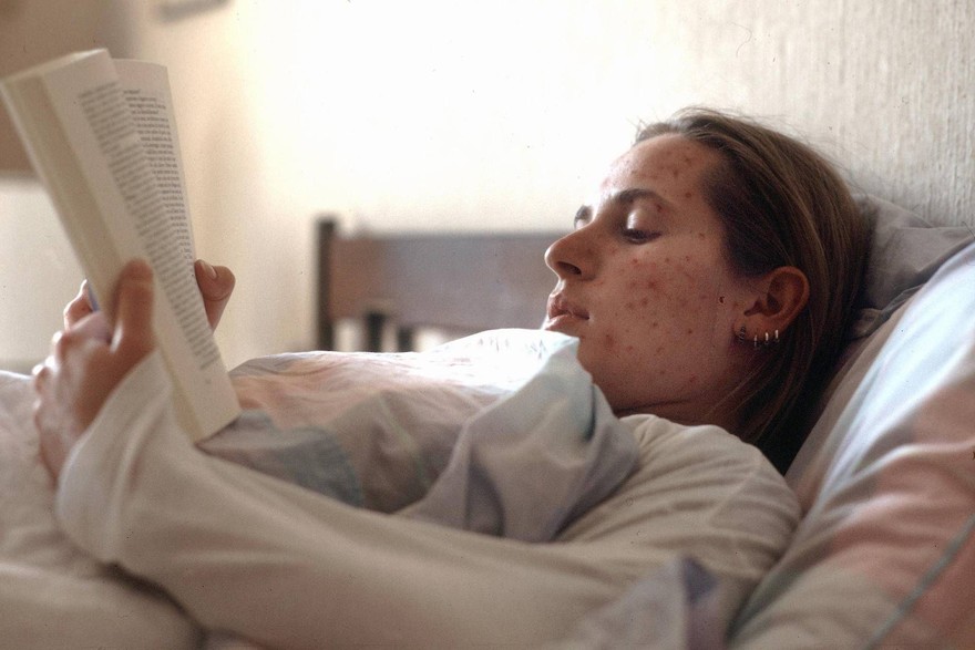 Morbillo, record di casi in Europa: 127.350 nel 2024